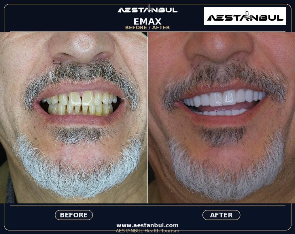 dental veneers before and after Turkey - Dental Veneers Before And After Turkey: Results, Safety and Patient Questions