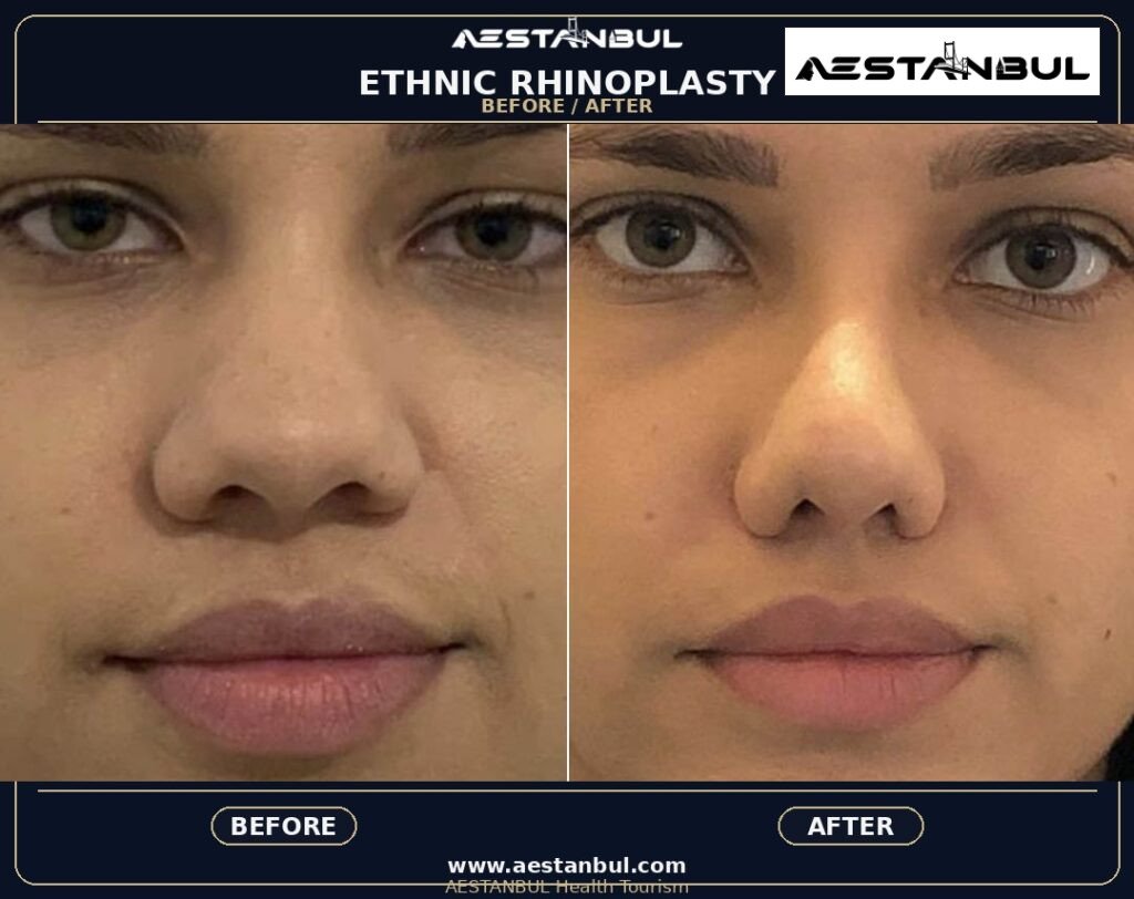 Rhinoplasty UK Checklist - Rhinoplasty Uk Checklist: UK Patient Checklist for 2026