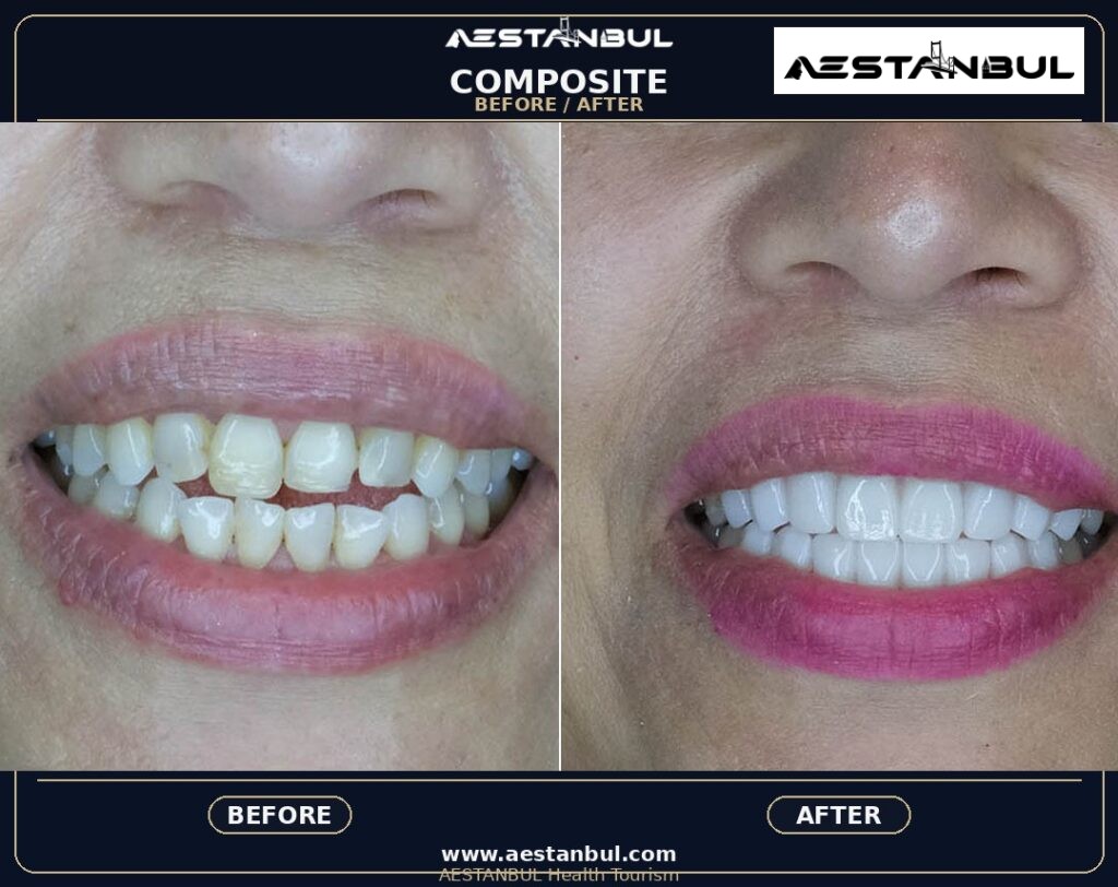 composite bonding Turkey - Composite Bonding Turkey: What International Patients Should Know