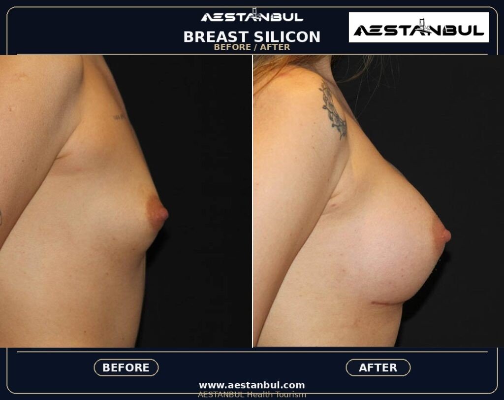 breast augmentation Turkey - Breast Augmentation Turkey: Patient Guide in Turkey
