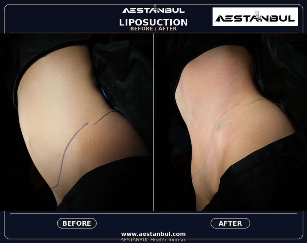 Liposuction Europe Package - Liposuction Europe Package: Package Review for European Patients for 2026
