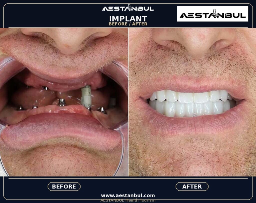 Dental Implants UK Checklist - Dental Implants Uk Checklist: UK Patient Checklist for 2026