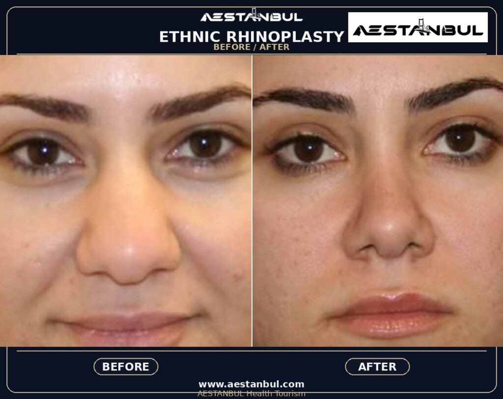 Rhinoplasty Uk Checklist: UK Patient Checklist for 2026 8 5a6f90ff