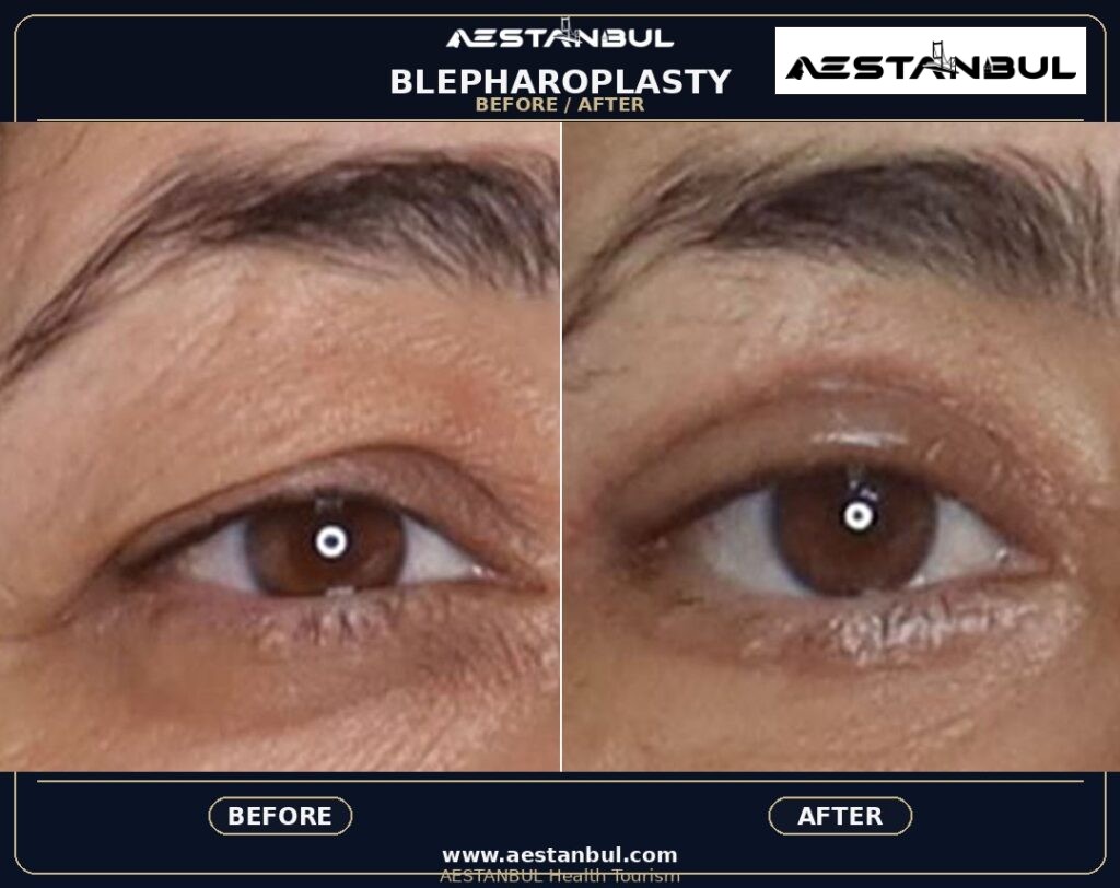 Blepharoplasty Europe Package - Blepharoplasty Europe Package: Package Review for European Patients for 2026