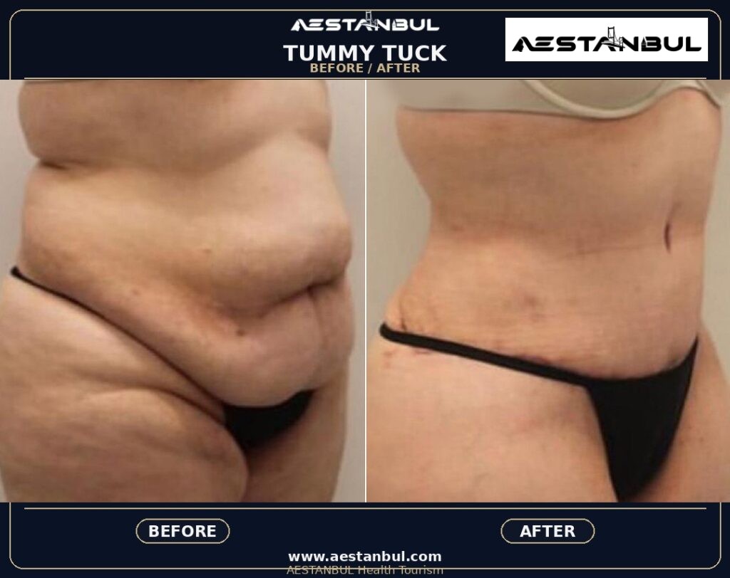 Tummy Tuck Deposit Questions - Tummy Tuck Deposit Questions: Deposit Questions Before Booking for 2026