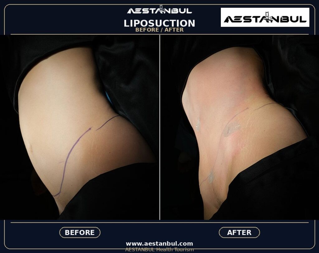 liposuction before and after Turkey - Liposuction Before And After Turkey: Results, Safety and Patient Questions