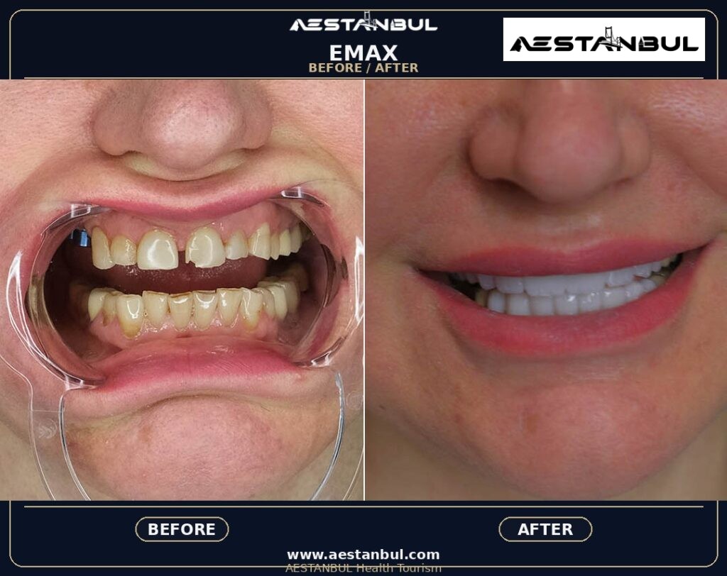 dental veneers before and after Turkey - Dental Veneers Before And After Turkey: Results, Safety and Patient Questions