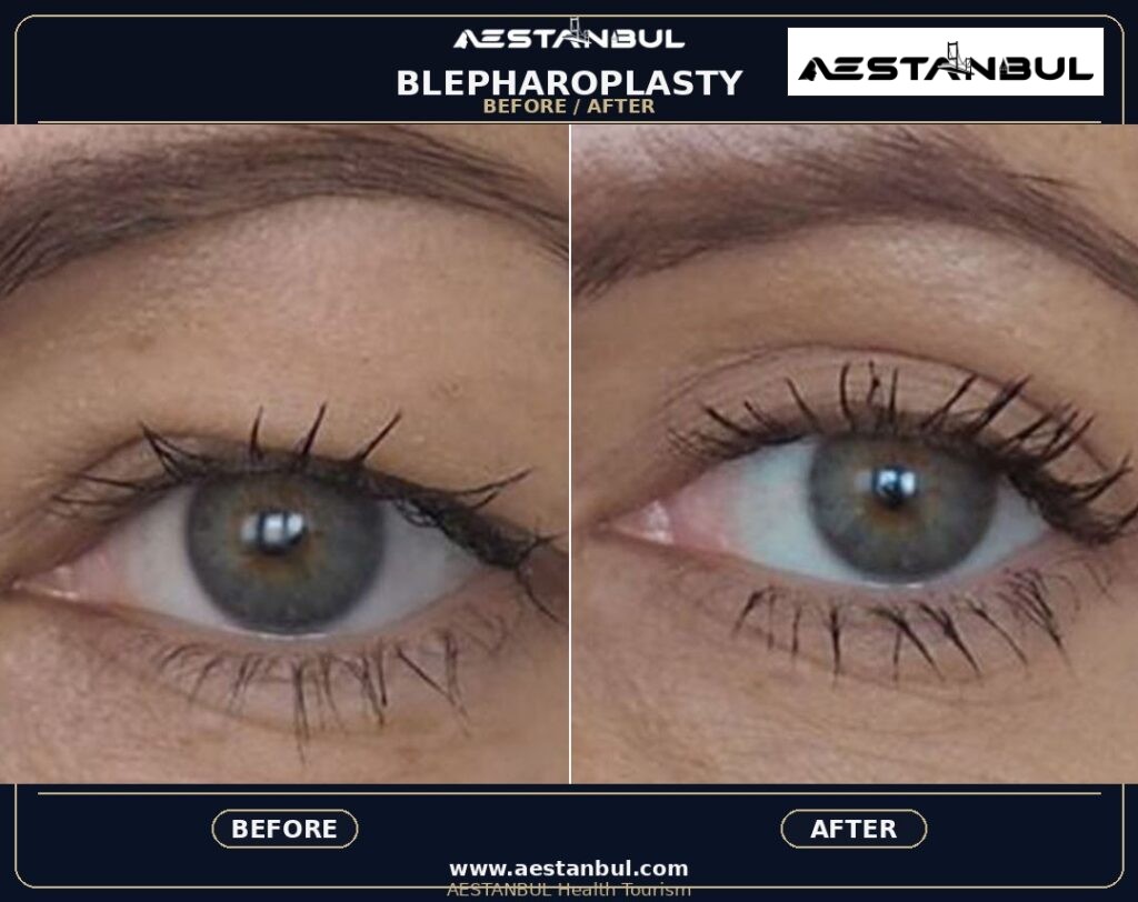 Blepharoplasty Europe Package - Blepharoplasty Europe Package: Package Review for European Patients for 2026