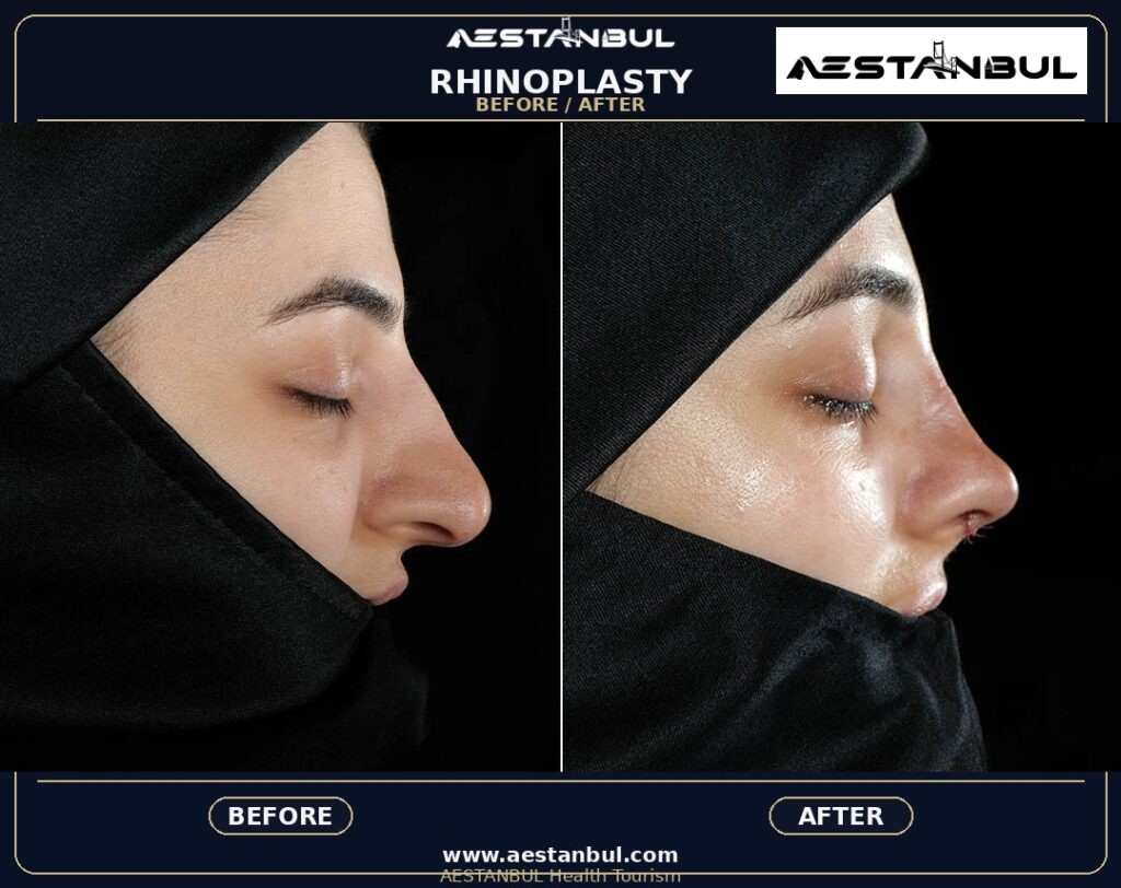 rhinoplasty before and after Turkey - Rhinoplasty Before And After Turkey: Results, Safety and Patient Questions