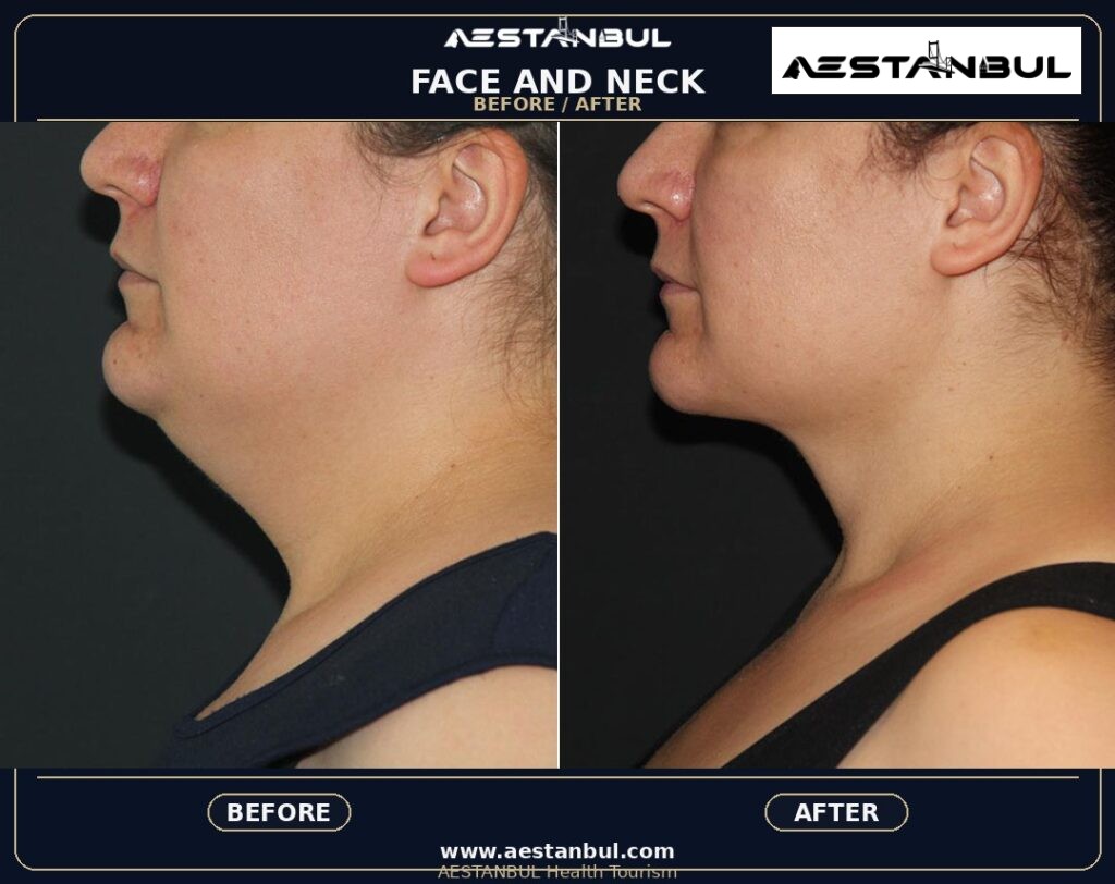 Facelift Aftercare Timeline - Facelift Aftercare Timeline: Aftercare Timeline Questions for 2026