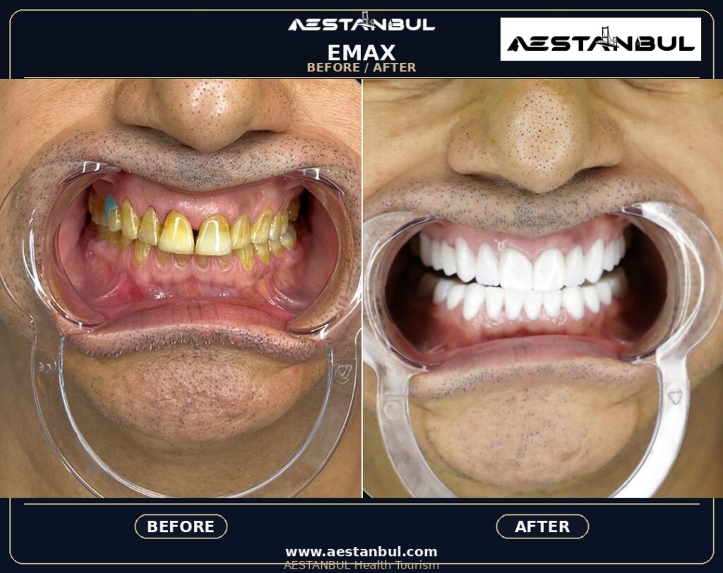 dental veneers before and after Turkey - Dental Veneers Before And After Turkey: Results, Safety and Patient Questions