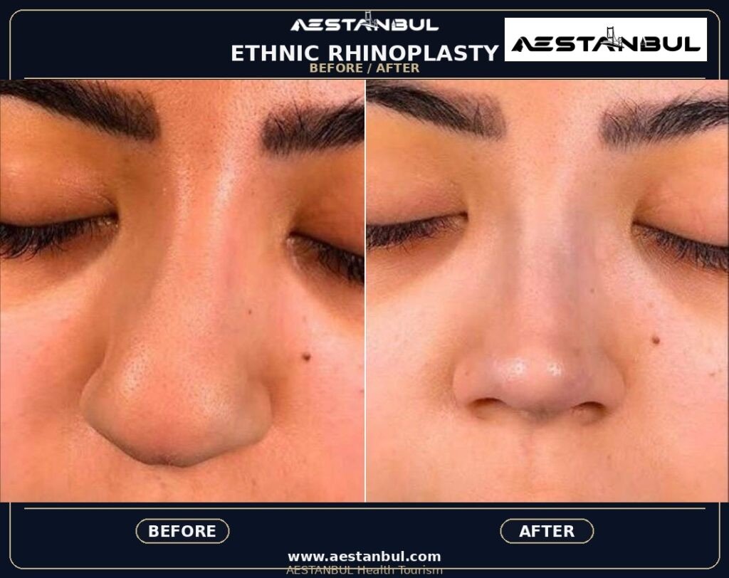 ethnic rhinoplasty Turkey - Ethnic Rhinoplasty Turkey: Patient Guide in Turkey