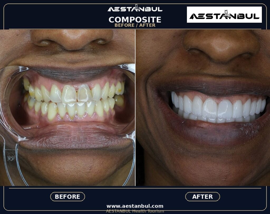 composite bonding Turkey - Composite Bonding Turkey: What International Patients Should Know