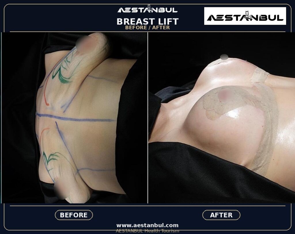 breast lift Turkey - Breast Lift Turkey: Patient Guide in Turkey