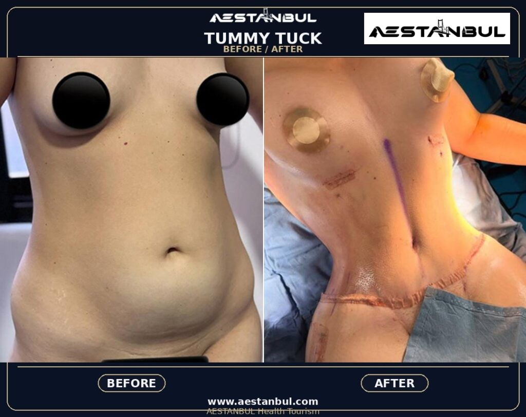 tummy tuck before and after Turkey - Tummy Tuck Before And After Turkey: Results, Safety and Patient Questions
