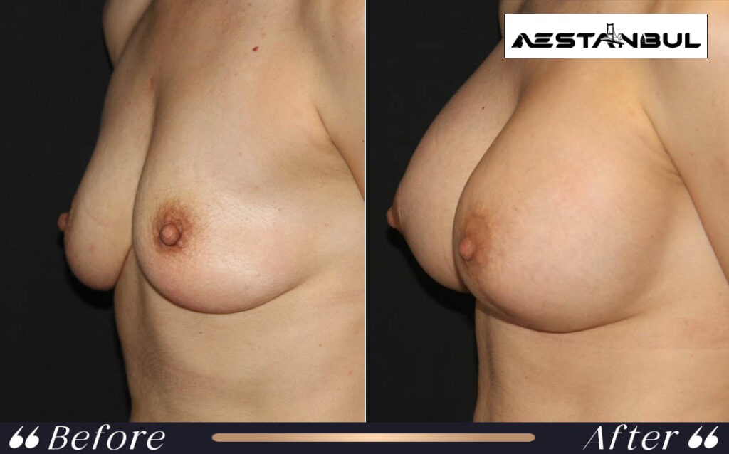 Breast Augmentation Implants Implant Surgery Result Istanbul Turkey 006