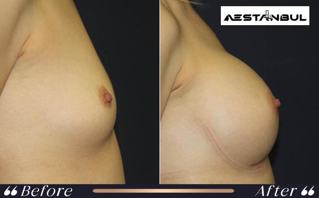 breast augmentation Turkey - Breast Augmentation Turkey: What International Patients Should Know