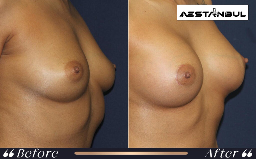 breast augmentation Turkey - Breast Augmentation Turkey: What International Patients Should Know
