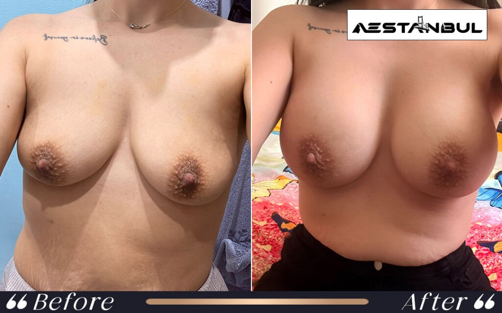 breast augmentation Turkey - Breast Augmentation Turkey: What International Patients Should Know