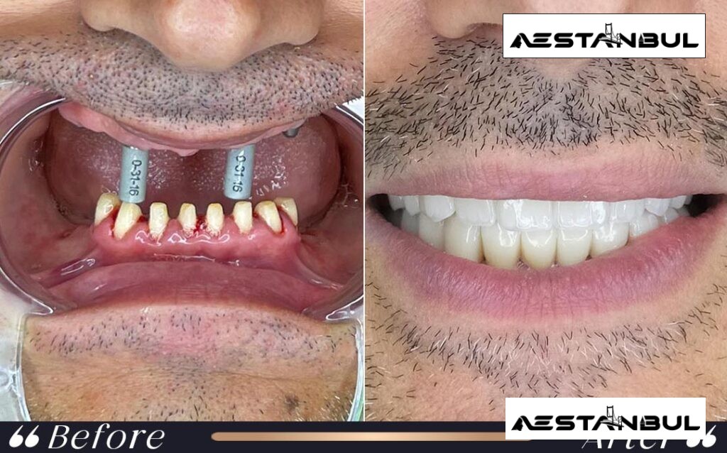 Dental Implants Implant Treatment Before After Istanbul Turkey 002