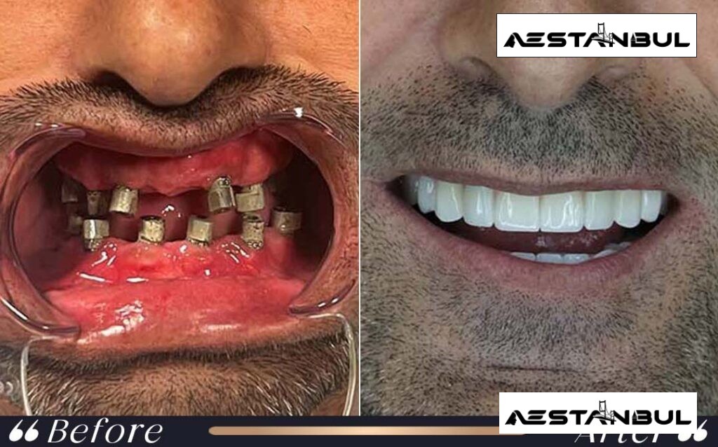 dental implants Turkey - Dental Implants Turkey: What International Patients Should Know