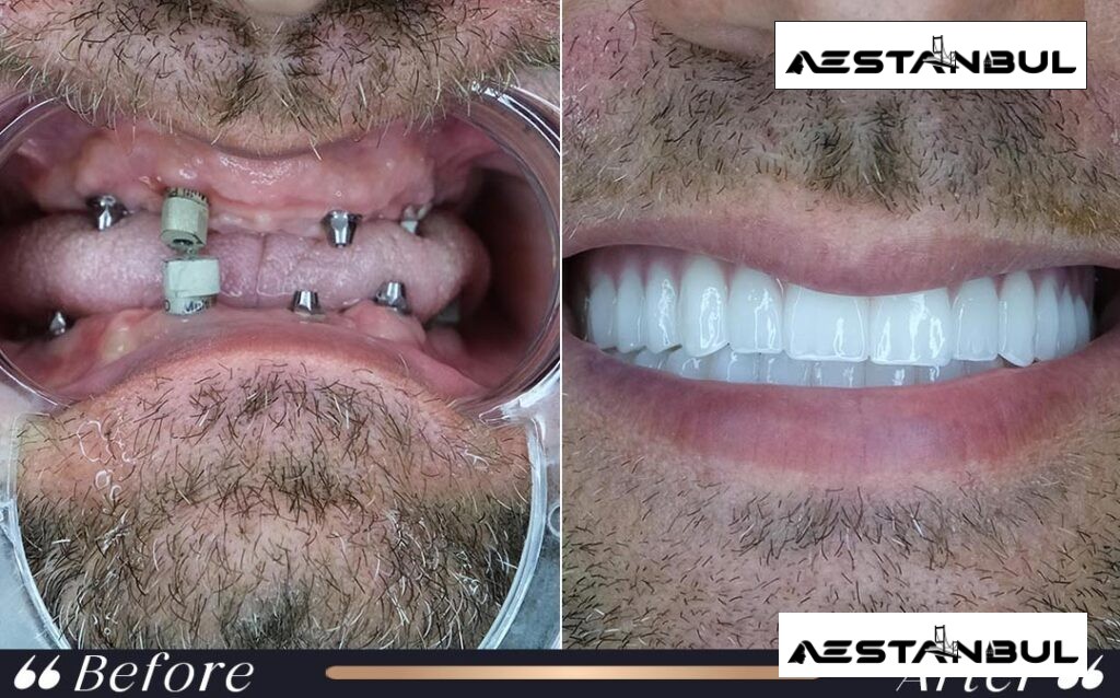 dental implants Turkey - Dental Implants Turkey: What International Patients Should Know