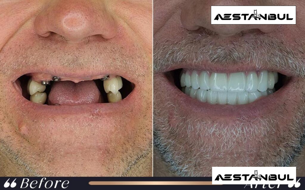 dental implants Turkey - Dental Implants Turkey: What International Patients Should Know