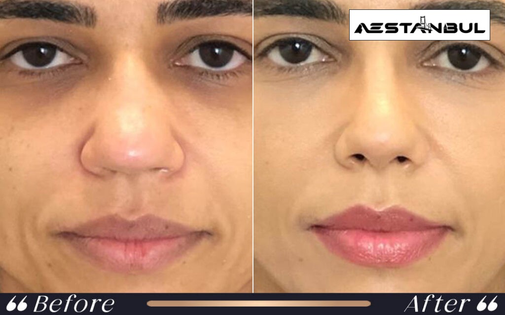 ethnic rhinoplasty Turkey - Ethnic Rhinoplasty Turkey: What International Patients Should Know
