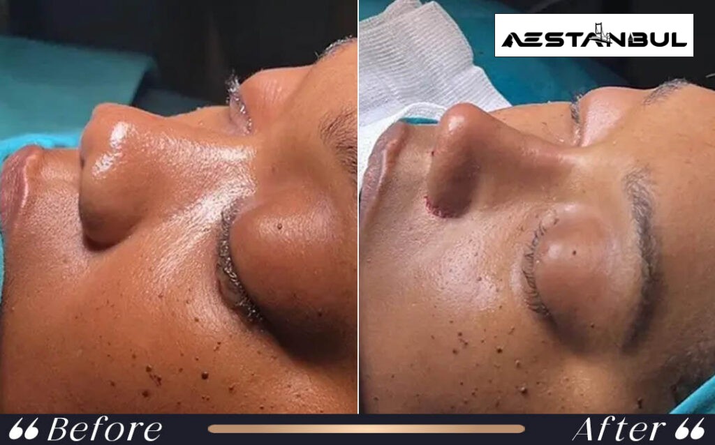 Ethnic Rhinoplasty Nose Surgery Before After Istanbul Turkey 010