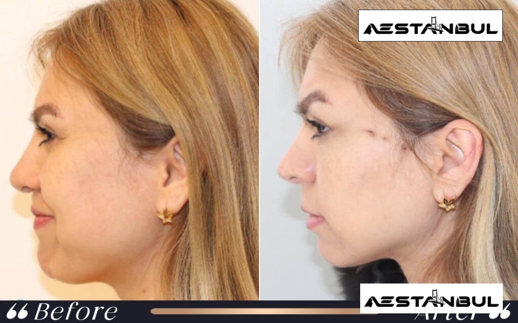 Face Neck Lift Facelift Before After Istanbul Turkey 002