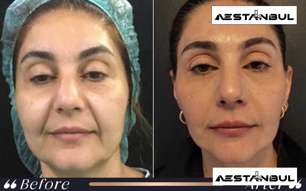 neck lift Turkey - Neck Lift Turkey: What International Patients Should Know