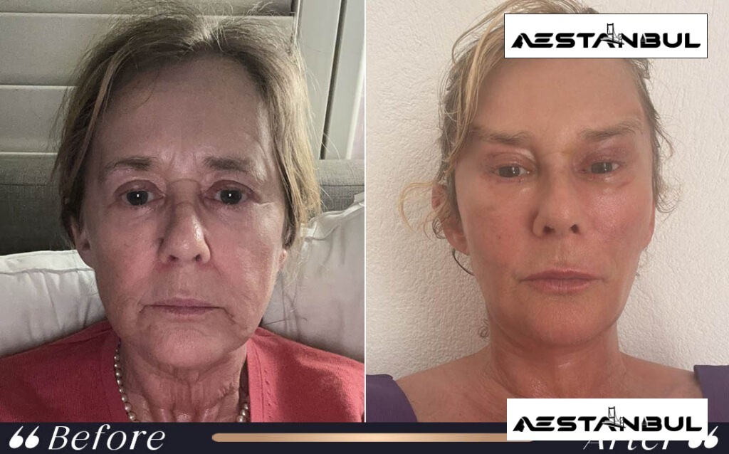 neck lift Turkey - Neck Lift Turkey: What International Patients Should Know