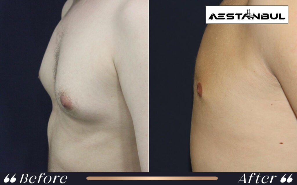 gynecomastia without surgery treatment - Gynecomastia Without Surgery Treatment: What International Patients Should Know