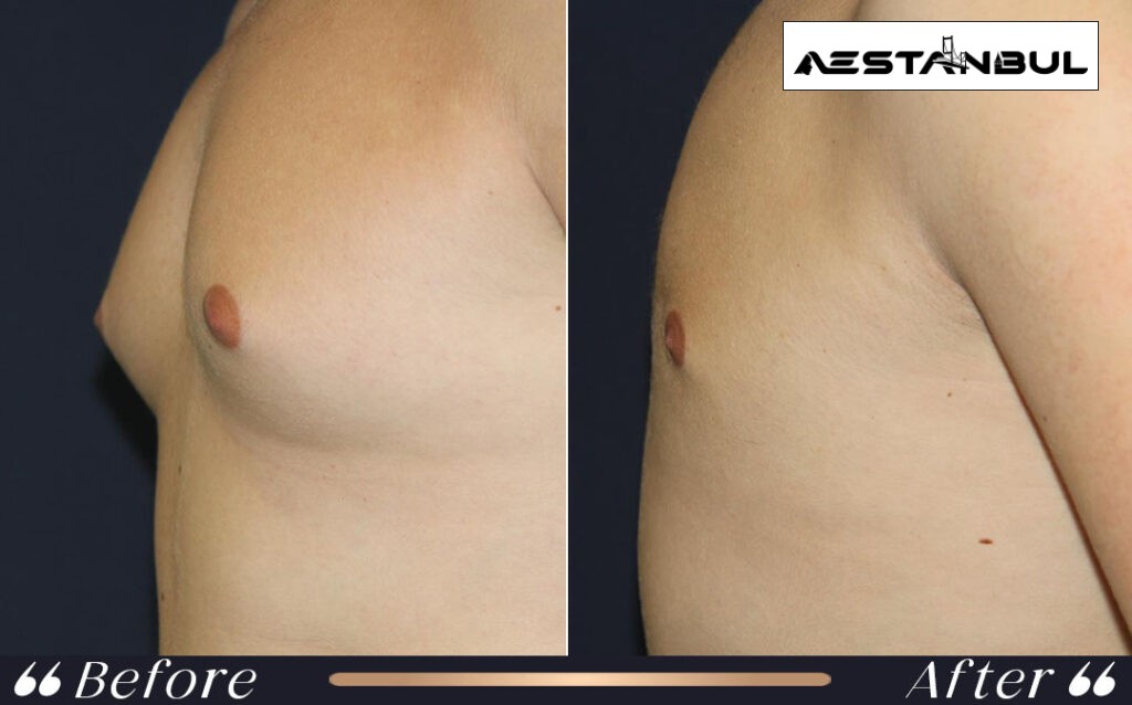 gynecomastia without surgery treatment - Gynecomastia Without Surgery Treatment: What International Patients Should Know