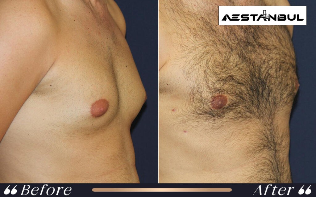 gynecomastia without surgery treatment - Gynecomastia Without Surgery Treatment: What International Patients Should Know