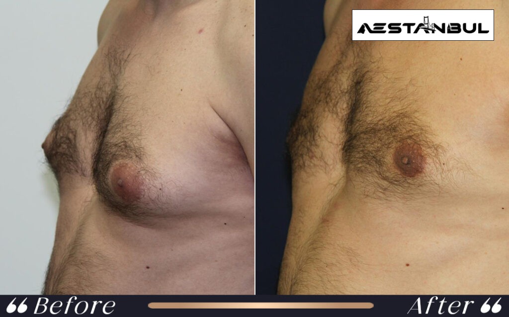 Gynecomastia Surgery Male Breast Reduction Before After Istanbul Turkey 002