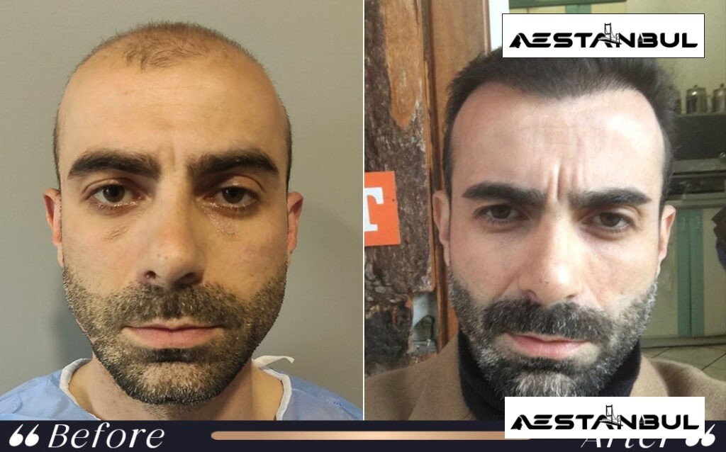 turkey hair transplant cost - Turkey Hair Transplant Cost: Cost, Safety and Clinic Planning