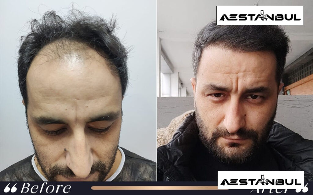 turkey hair transplant cost - Turkey Hair Transplant Cost: Cost, Safety and Clinic Planning