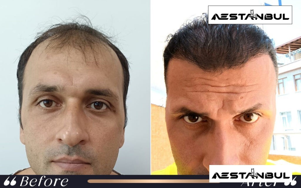 turkey hair transplant cost - Turkey Hair Transplant Cost: Cost, Safety and Clinic Planning