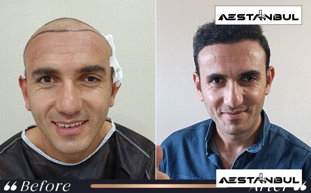Hair Transplant Hairline Result Istanbul Turkey 005