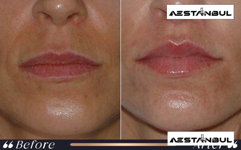 Lip Filler After Treatment Istanbul Turkey 004