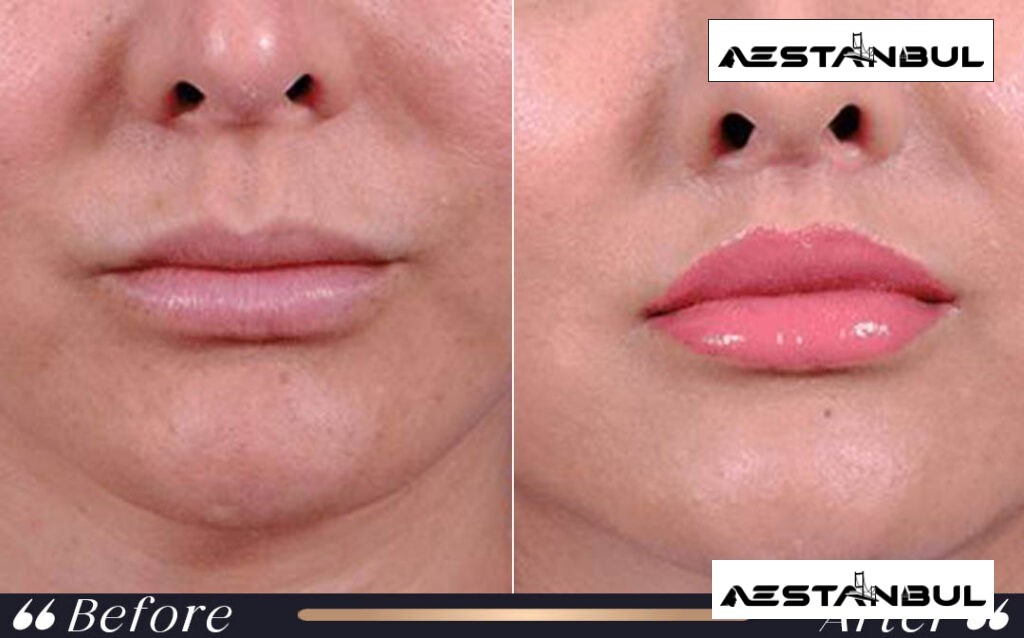 under eye light filler Turkey - Under Eye Light Filler Turkey: What International Patients Should Know