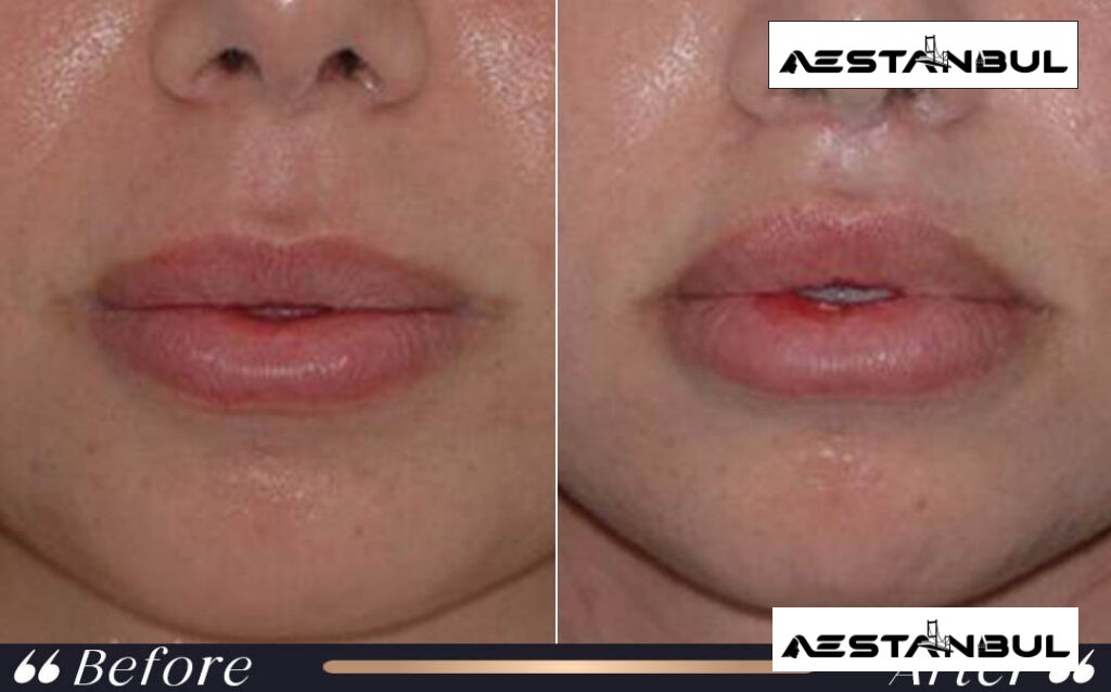 under eye light filler Turkey - Under Eye Light Filler Turkey: What International Patients Should Know
