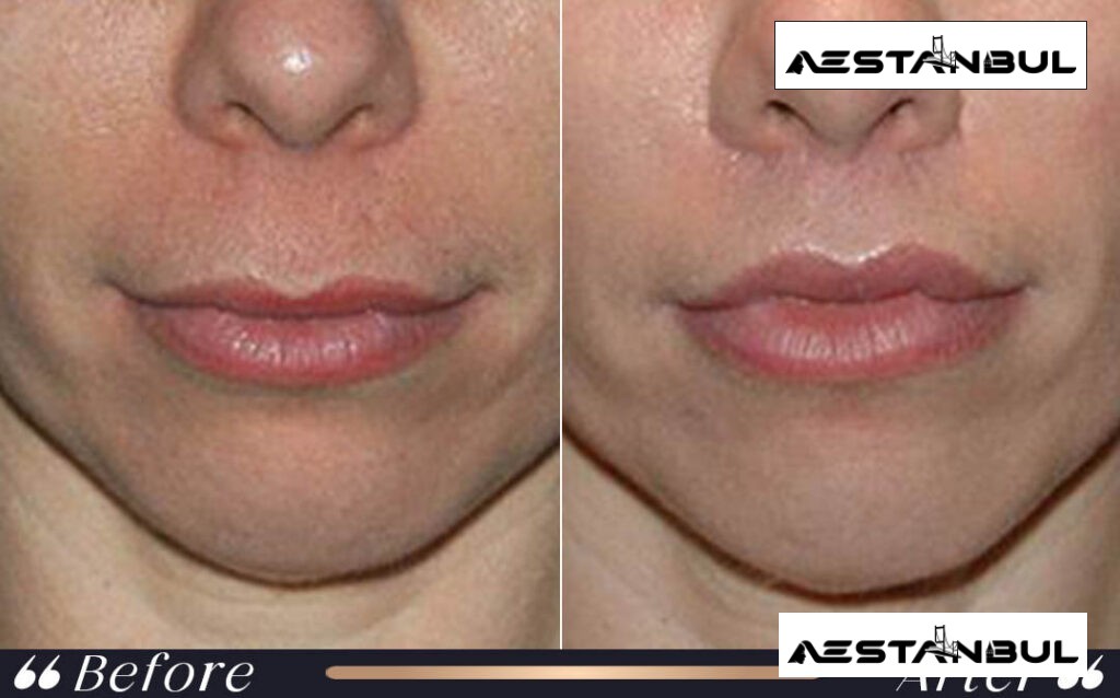 under eye light filler Turkey - Under Eye Light Filler Turkey: What International Patients Should Know