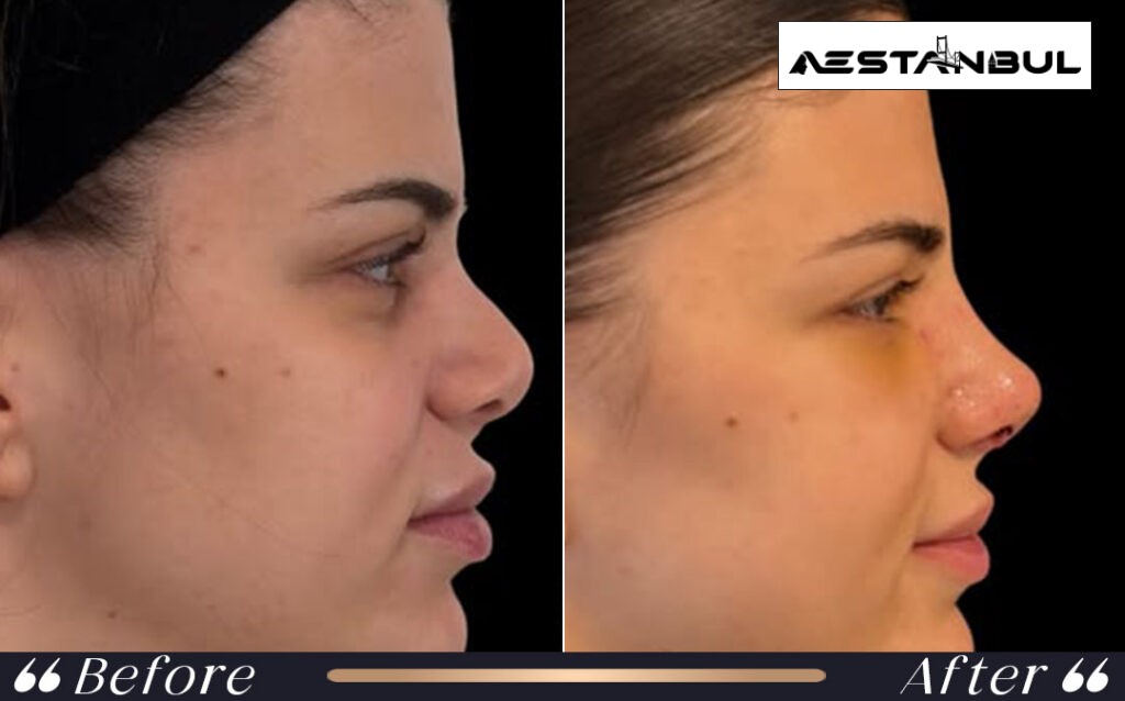 revision rhinoplasty Turkey - Revision Rhinoplasty Turkey: What International Patients Should Know