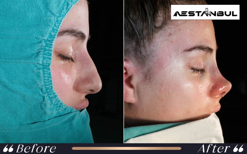 revision rhinoplasty Turkey - Revision Rhinoplasty Turkey: What International Patients Should Know