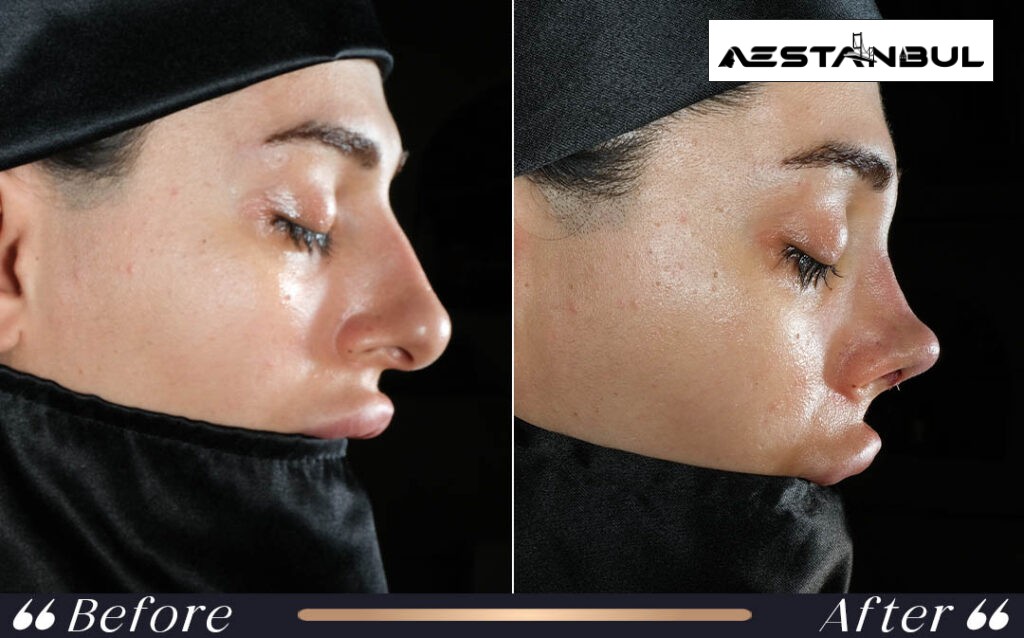 ethnic rhinoplasty Turkey - Ethnic Rhinoplasty Turkey: What International Patients Should Know