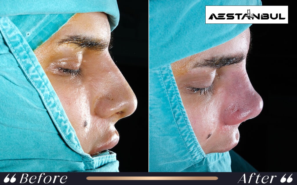 ethnic rhinoplasty Turkey - Ethnic Rhinoplasty Turkey: What International Patients Should Know