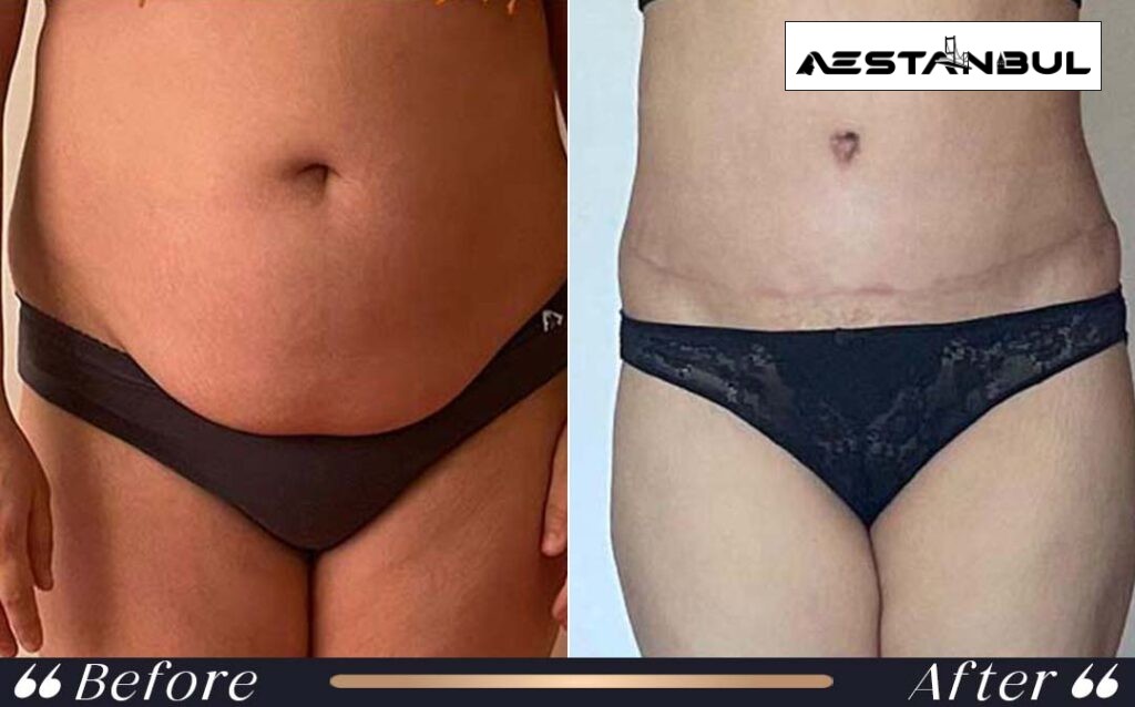 Tummy Tuck Abdominoplasty After Surgery Istanbul Turkey 005