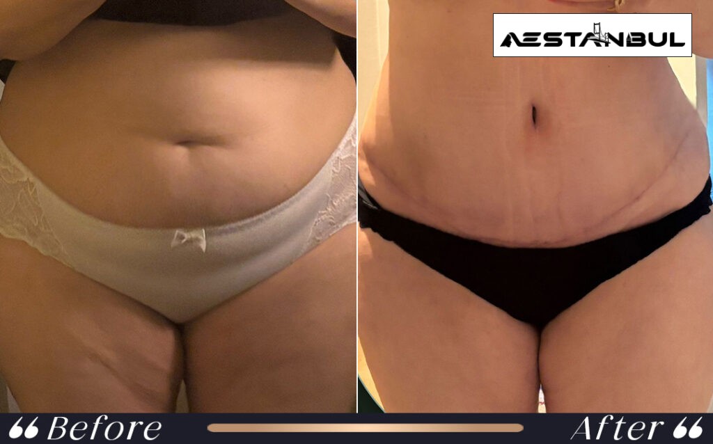 does fat come back after liposuction - Does Fat Come Back After Liposuction: What International Patients Should Know